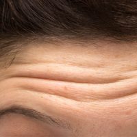 Anti-Wrinkle-Injections-Eternal-Youth-Medical-Aesthetics-01 Anti Wrinkle Injections Eternal Youth Medical Aesthetics 01