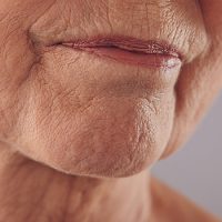 Anti-Wrinkle-Injections-Eternal-Youth-Medical-Aesthetics-10 Anti Wrinkle Injections Eternal Youth Medical Aesthetics 10