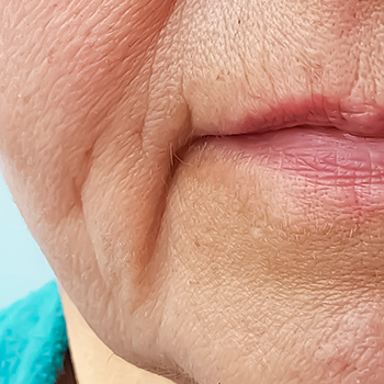 Dermal Fillers & Facial Treatments | Eternal Youth Medical