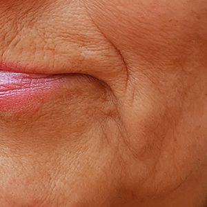 Perioral Sculpting Eternal Youth Medical Aesthetics